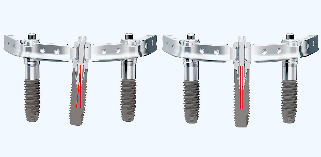 Unikali apatinio žandikaulio ant 3-jų implantų „Trefoil“ sistema – naujos kokybės šuolis odontologijos istorijoje