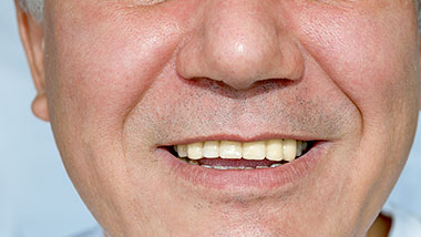 Momentinis dantų implantavimas